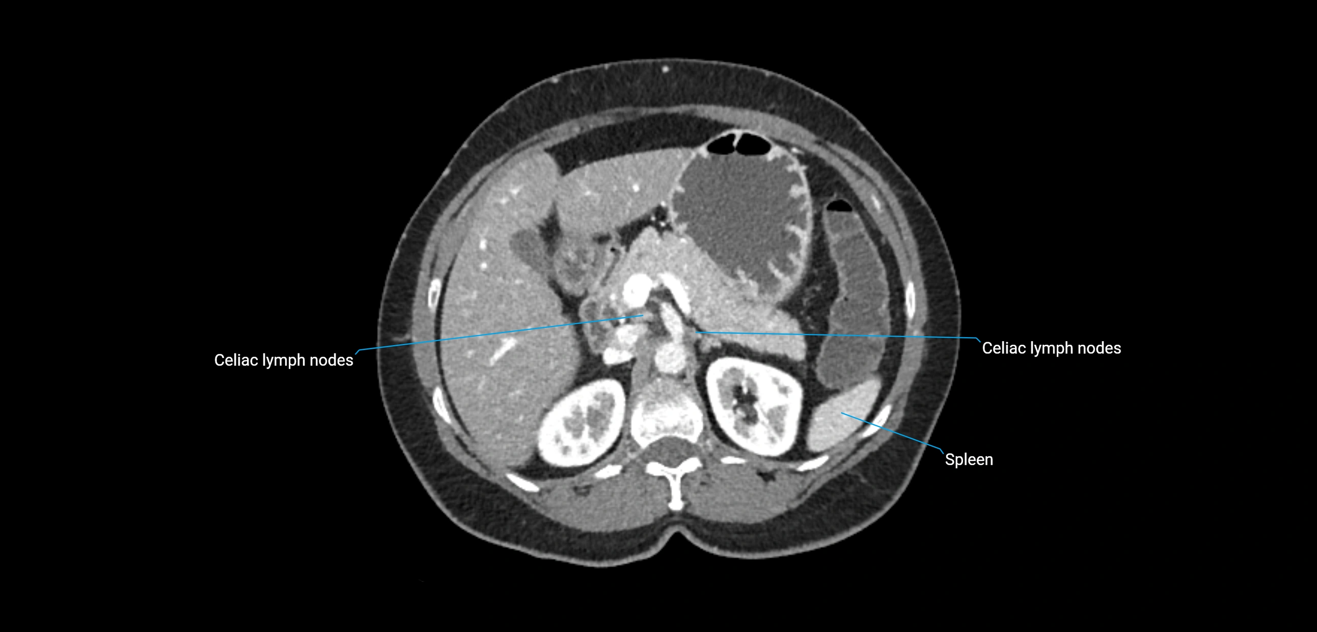 CT ct abdominal lymph nodes  axial cross sectional anatomy  enchanced radiology image -img-00002-00151.webp